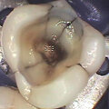 Cracked tooth 1