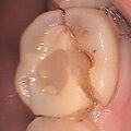 Cracked tooth 3